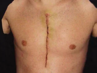 Narbenpflege-nach-Herzoperation