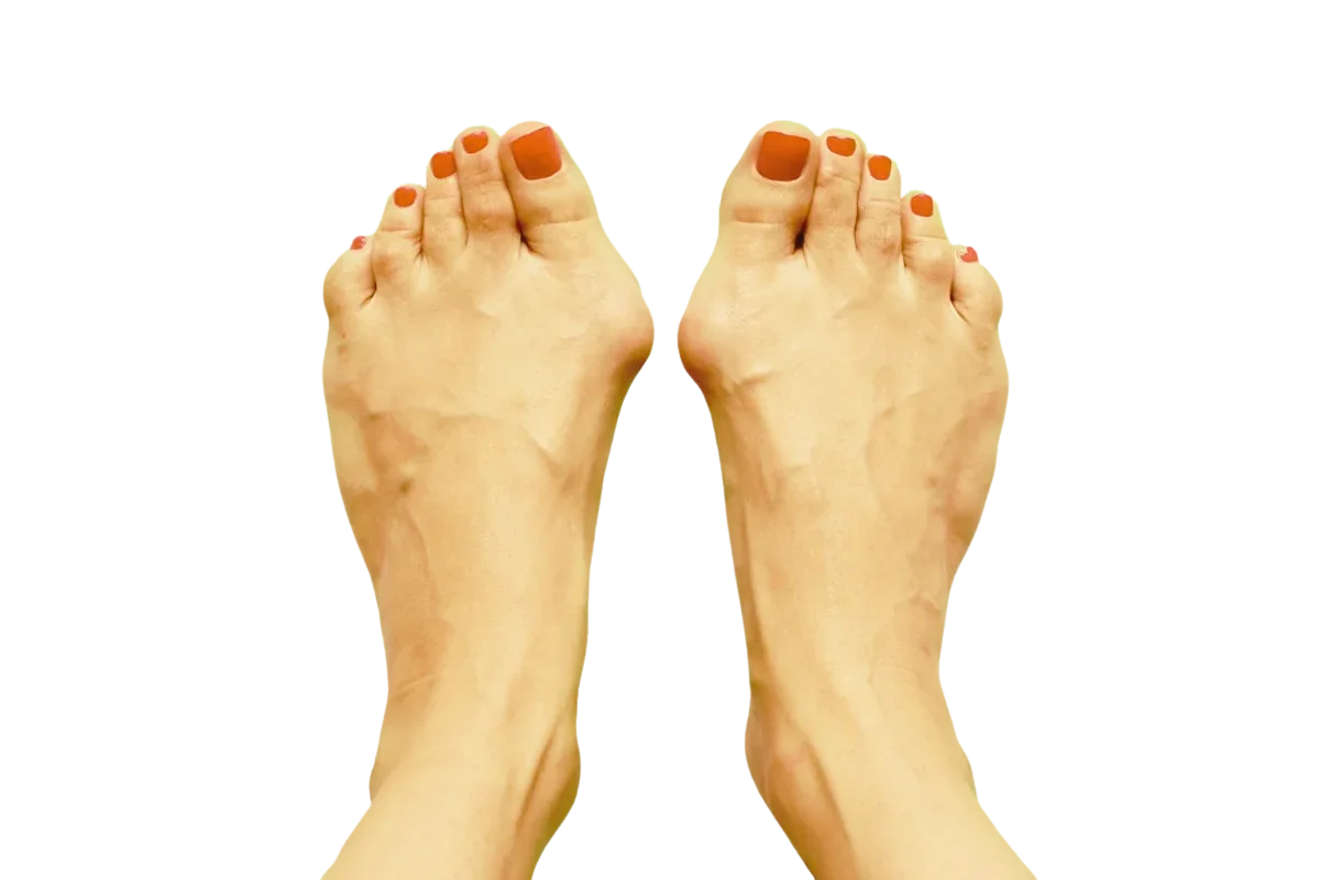 Narbenpflege nach Hallux Valgus Operation