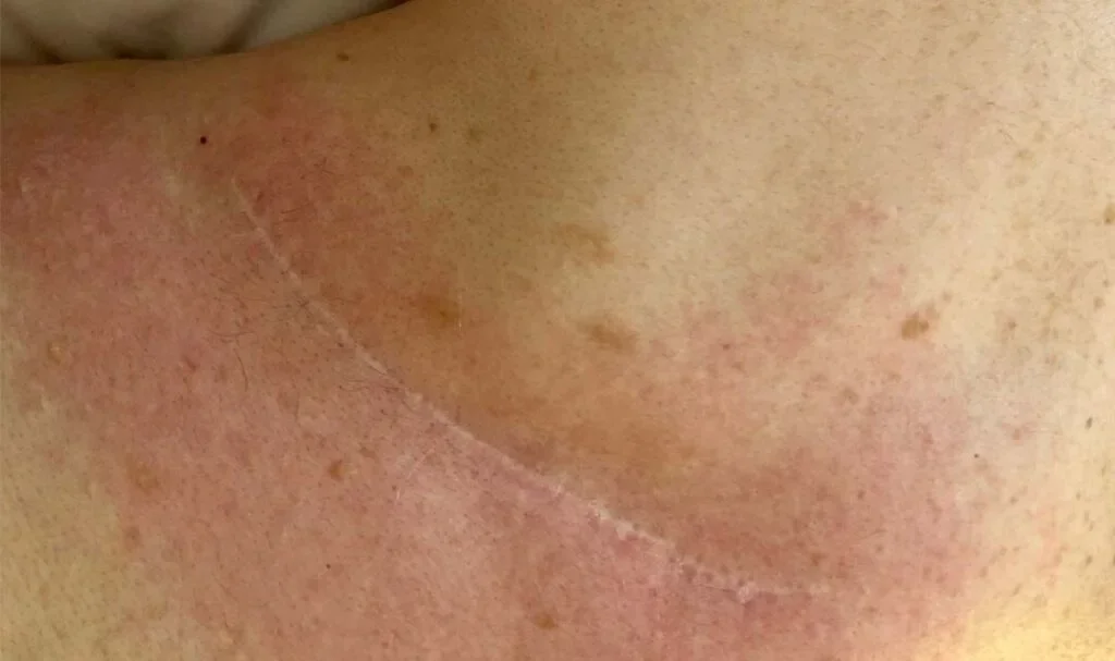 Professionelle Narbenbehandlung bei Neoscar